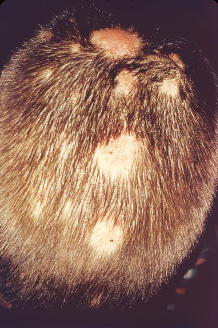 What is tinea capitis